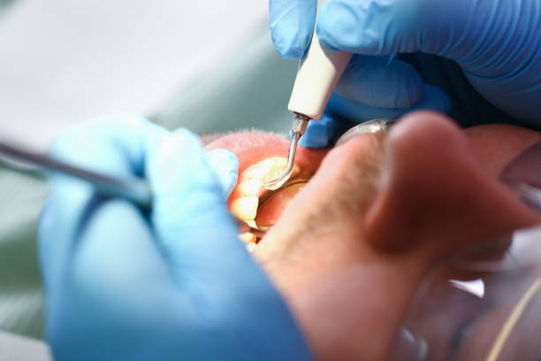Best Emergency Treatment for Dental Infections or Abscesses in City View, SC