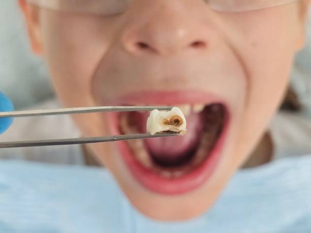 Best Urgent Care for Lost Fillings or Crowns in City View, SC