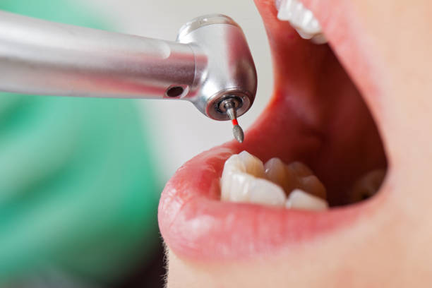Best Emergency Dental Care for Broken or Chipped Teeth in City View, SC